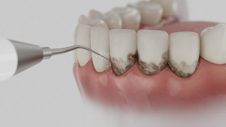 Trusted Wisdom Tooth Removal service in Los Ranchos, CA - Dentist Open Now